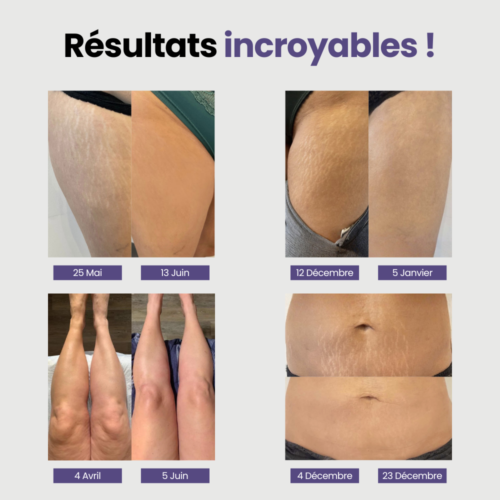 Nervalis Anti-Stretch Mark Cream